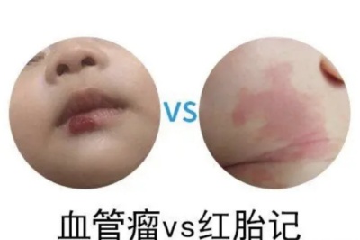 怎么判断是血管瘤还是胎记？